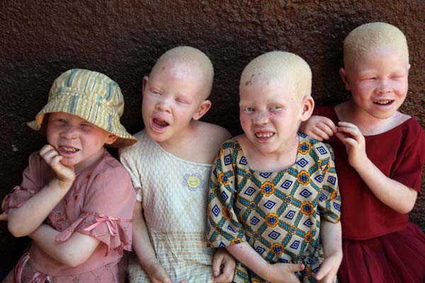 Albino children in Tanzania - Albinism in Africa