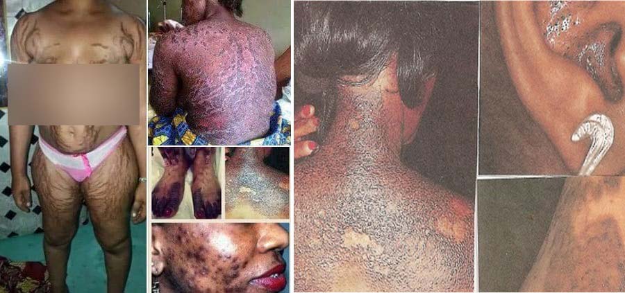 Some cases of the adverse effects of skin bleaching