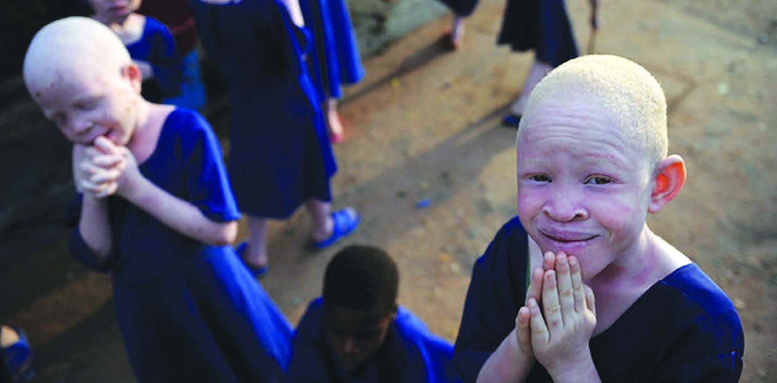 albinisim in africa_blog.swaliafrica.com _